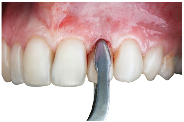 EXTRACCIONES DENTALES heredia EXTRACCIONES DENTALES heredia