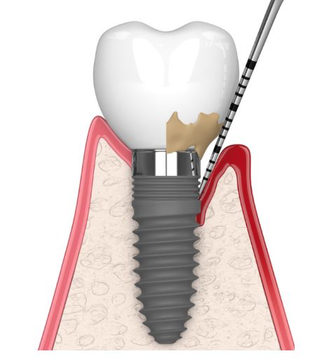 PERIIMPLANTITIS heredia PERIIMPLANTITIS heredia