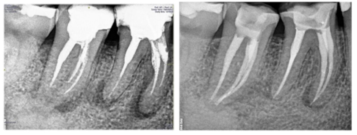 RETRATAMIENTO ENDODONTICO heredia RETRATAMIENTO ENDODONTICO heredia